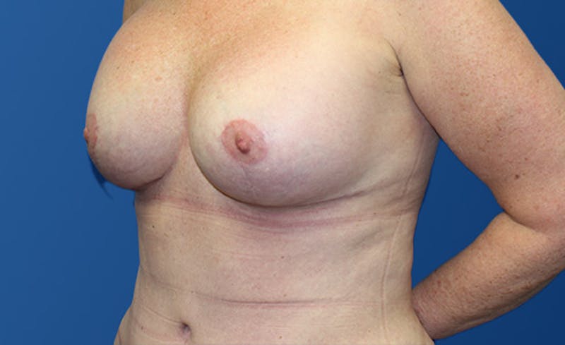 Abdominoplasty Before & After Gallery - Patient 280932 - Image 4