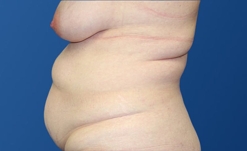 Abdominoplasty Before & After Gallery - Patient 280932 - Image 5
