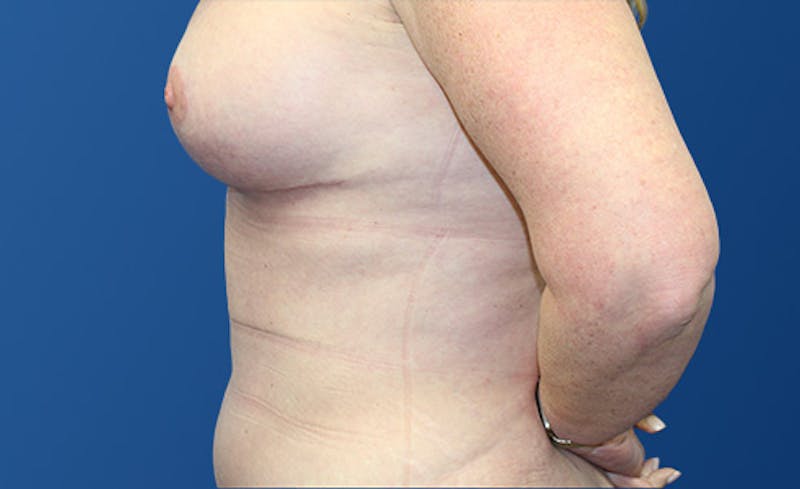 Abdominoplasty Before & After Gallery - Patient 280932 - Image 6