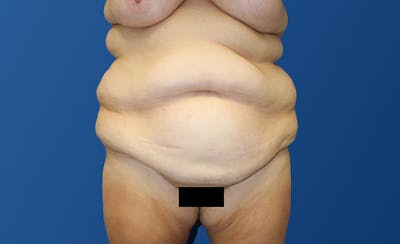 Abdominoplasty Before & After Gallery - Patient 281974 - Image 1