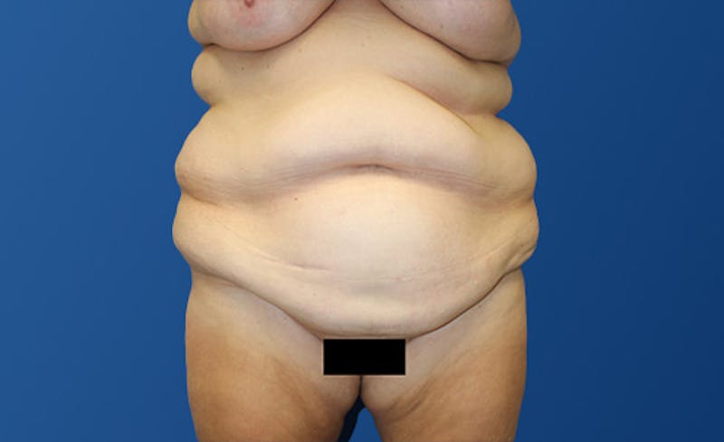 Abdominoplasty Before & After Gallery - Patient 281974 - Image 1