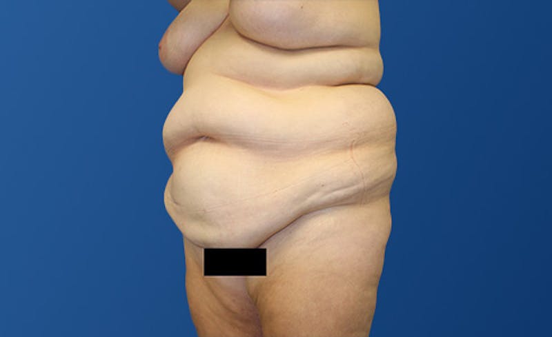 Abdominoplasty Before & After Gallery - Patient 281974 - Image 3