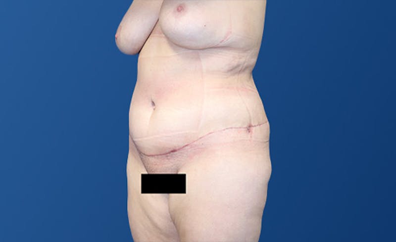 Abdominoplasty Before & After Gallery - Patient 281974 - Image 4