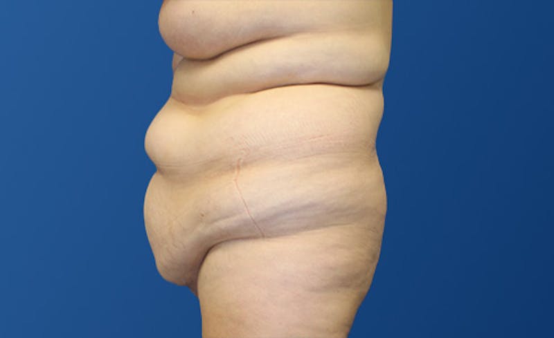 Abdominoplasty Before & After Gallery - Patient 281974 - Image 5