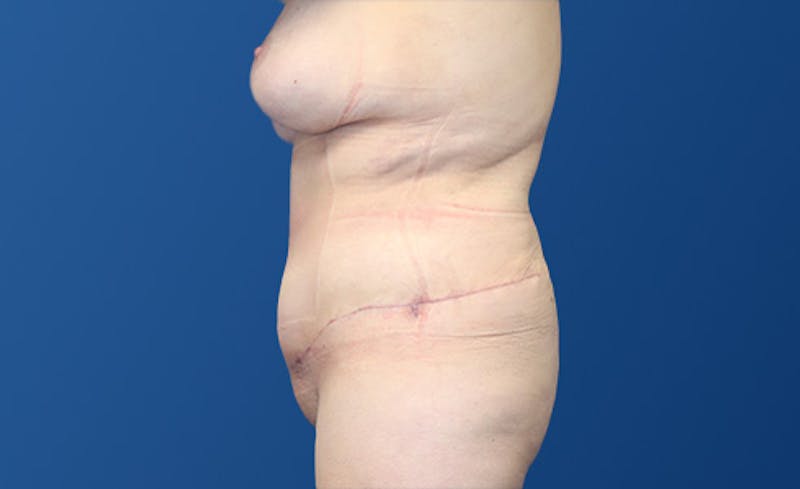 Abdominoplasty Before & After Gallery - Patient 281974 - Image 6