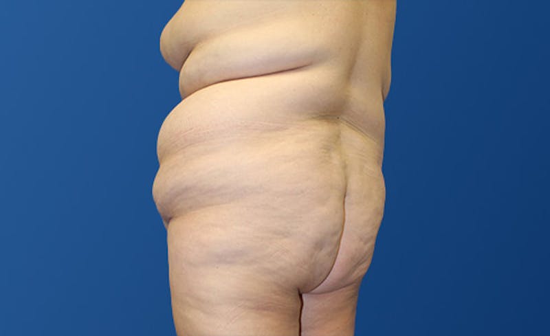 Abdominoplasty Before & After Gallery - Patient 281974 - Image 7