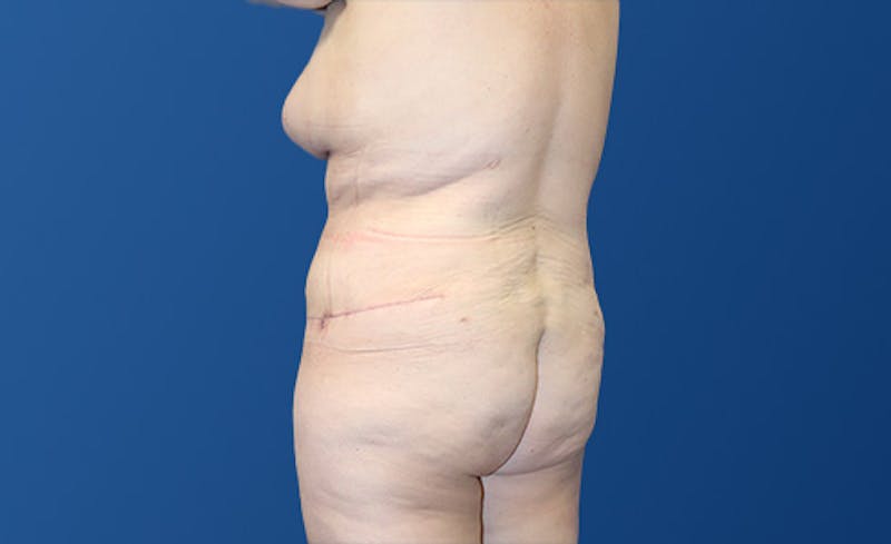 Abdominoplasty Before & After Gallery - Patient 281974 - Image 8