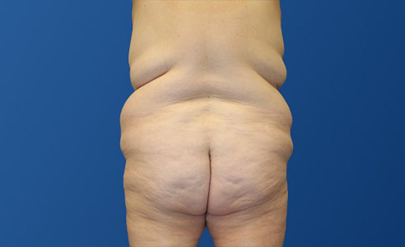 Abdominoplasty Before & After Gallery - Patient 281974 - Image 9