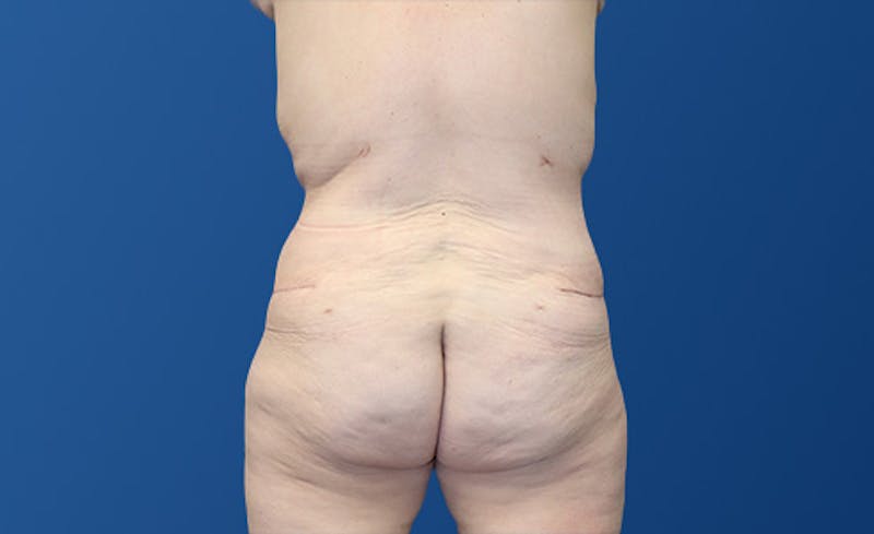 Abdominoplasty Before & After Gallery - Patient 281974 - Image 10