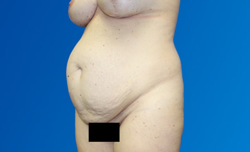 Abdominoplasty Before & After Gallery - Patient 220267 - Image 3