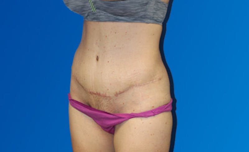 Abdominoplasty Before & After Gallery - Patient 220267 - Image 4