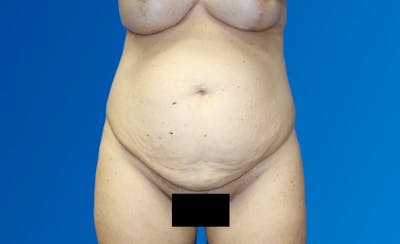 Abdominoplasty Before & After Gallery - Patient 220267 - Image 1