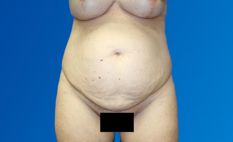 Abdominoplasty Before & After Gallery - Patient 220267 - Image 1