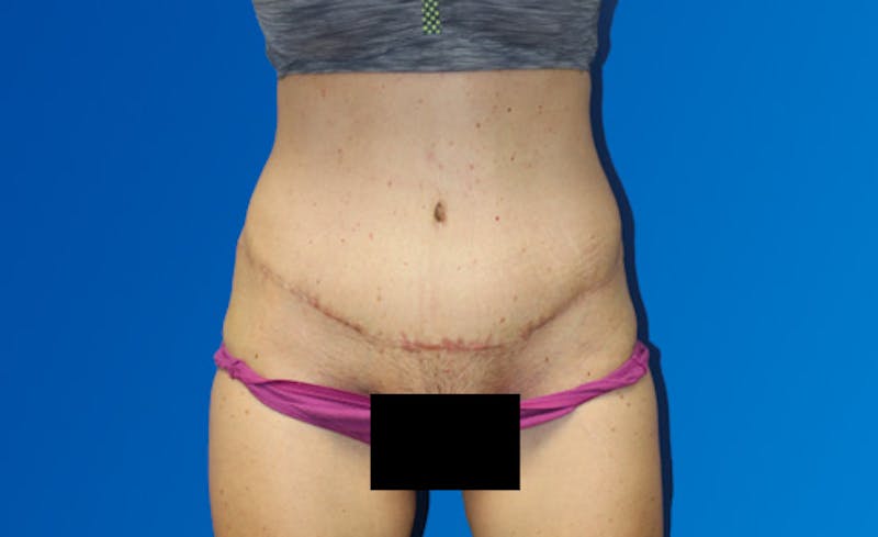 Abdominoplasty Before & After Gallery - Patient 220267 - Image 2