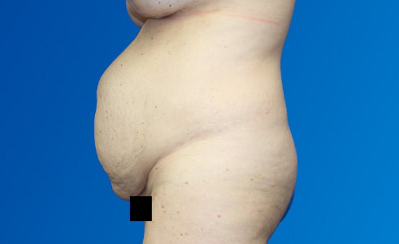 Abdominoplasty Before & After Gallery - Patient 220267 - Image 5
