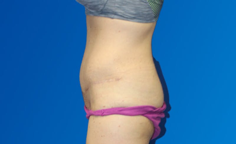 Abdominoplasty Before & After Gallery - Patient 220267 - Image 6