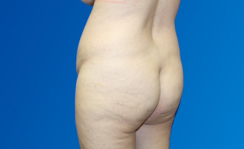 Abdominoplasty Before & After Gallery - Patient 220267 - Image 7