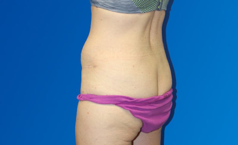 Abdominoplasty Before & After Gallery - Patient 220267 - Image 8