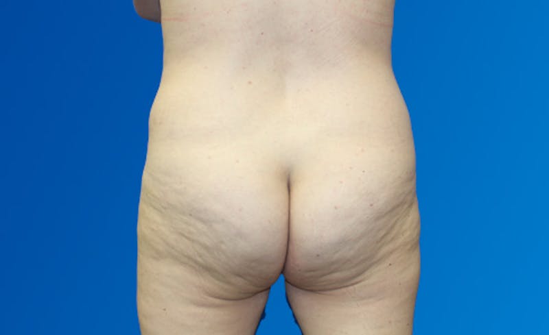 Abdominoplasty Before & After Gallery - Patient 220267 - Image 9