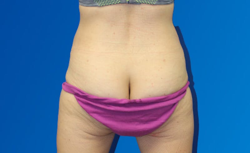 Abdominoplasty Before & After Gallery - Patient 220267 - Image 10