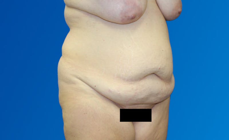 Abdominoplasty Before & After Gallery - Patient 377372 - Image 3