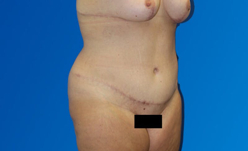 Abdominoplasty Before & After Gallery - Patient 377372 - Image 4