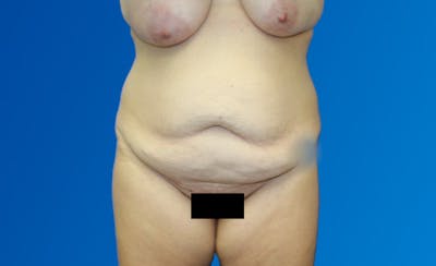 Abdominoplasty Before & After Gallery - Patient 377372 - Image 1
