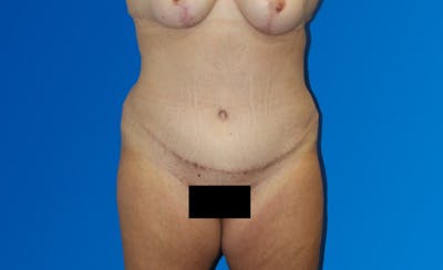 Abdominoplasty Before & After Gallery - Patient 377372 - Image 2