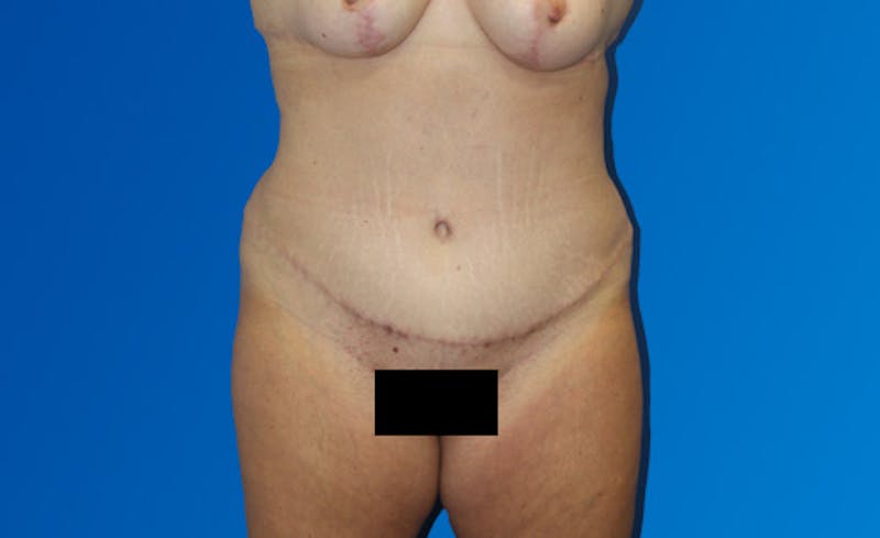 Abdominoplasty Before & After Gallery - Patient 377372 - Image 2