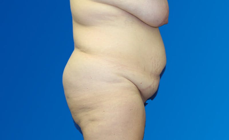 Abdominoplasty Before & After Gallery - Patient 377372 - Image 5