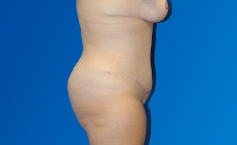 Abdominoplasty Before & After Gallery - Patient 377372 - Image 6
