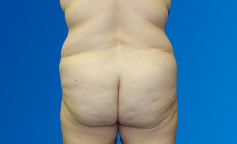 Abdominoplasty Before & After Gallery - Patient 377372 - Image 7