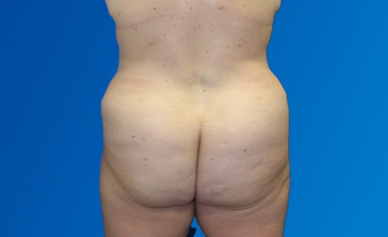 Abdominoplasty Before & After Gallery - Patient 377372 - Image 8