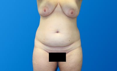 Abdominoplasty Before & After Gallery - Patient 130317 - Image 1