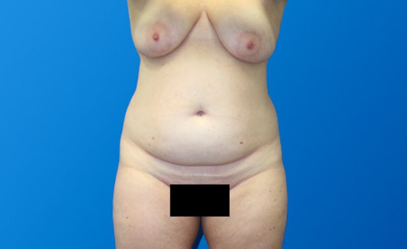Abdominoplasty Before & After Gallery - Patient 130317 - Image 1