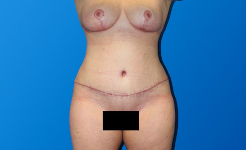 Abdominoplasty Before & After Gallery - Patient 130317 - Image 2