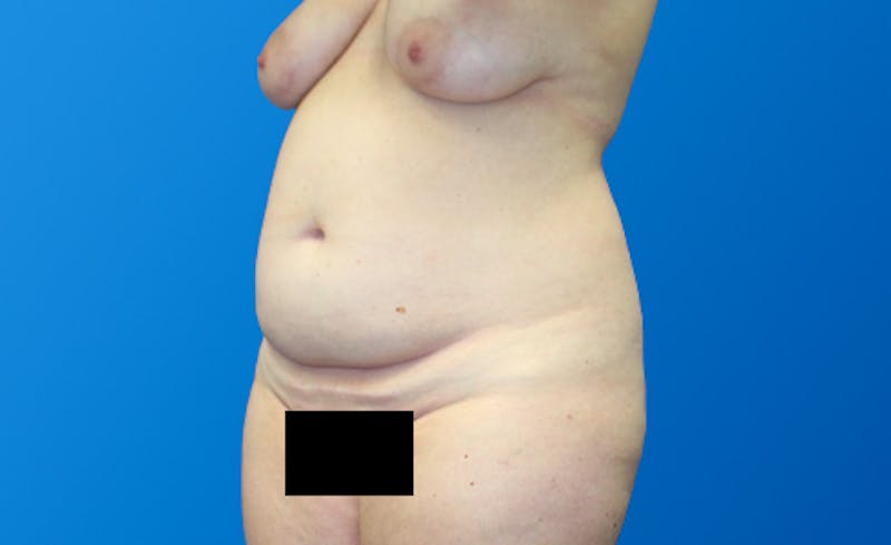 Abdominoplasty Before & After Gallery - Patient 130317 - Image 3