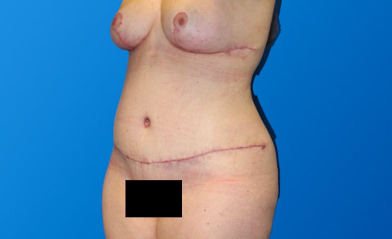 Abdominoplasty Before & After Gallery - Patient 130317 - Image 4