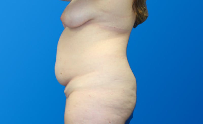 Abdominoplasty Before & After Gallery - Patient 130317 - Image 5