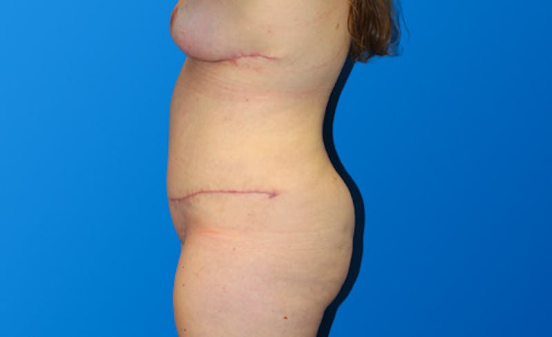 Abdominoplasty Before & After Gallery - Patient 130317 - Image 6
