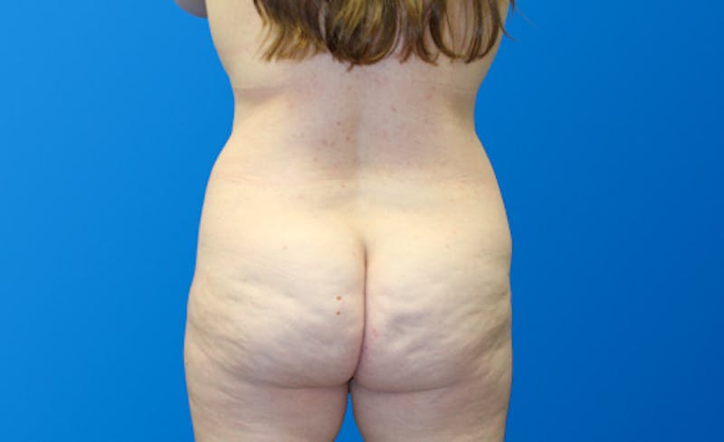 Abdominoplasty Before & After Gallery - Patient 130317 - Image 11