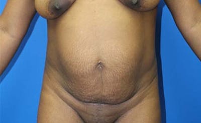 Abdominoplasty Before & After Gallery - Patient 147540 - Image 1