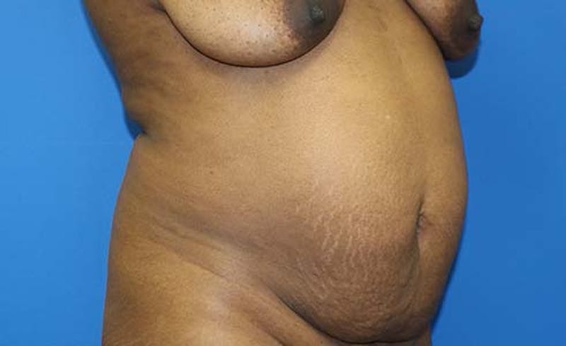 Abdominoplasty Before & After Gallery - Patient 147540 - Image 3