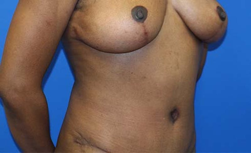 Abdominoplasty Before & After Gallery - Patient 147540 - Image 4