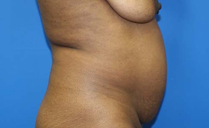 Abdominoplasty Before & After Gallery - Patient 147540 - Image 5