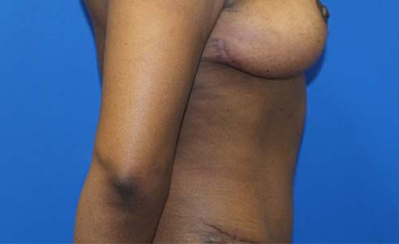 Abdominoplasty Before & After Gallery - Patient 147540 - Image 6