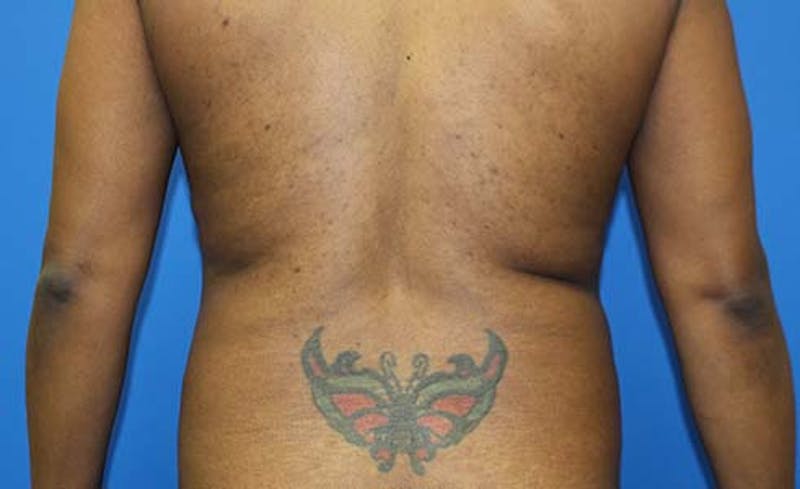 Abdominoplasty Before & After Gallery - Patient 147540 - Image 7