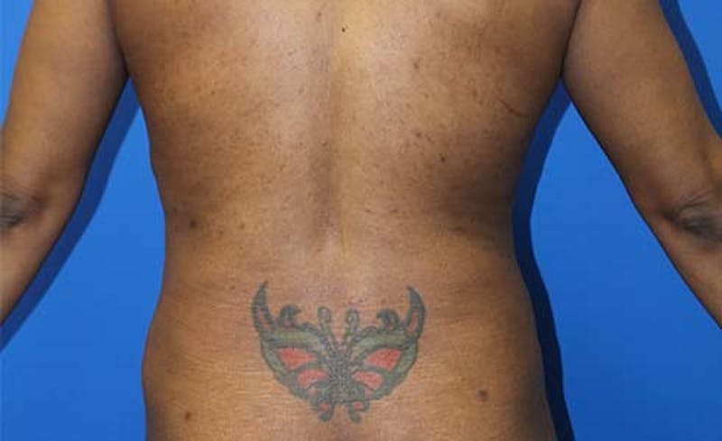 Abdominoplasty Before & After Gallery - Patient 147540 - Image 8
