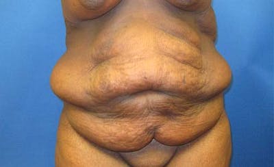 Abdominoplasty Before & After Gallery - Patient 130056 - Image 1