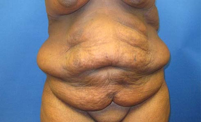 Abdominoplasty Before & After Gallery - Patient 130056 - Image 1